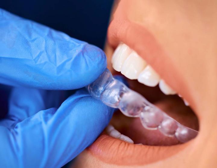 Des experts en pose de plaque de protection occlusale.