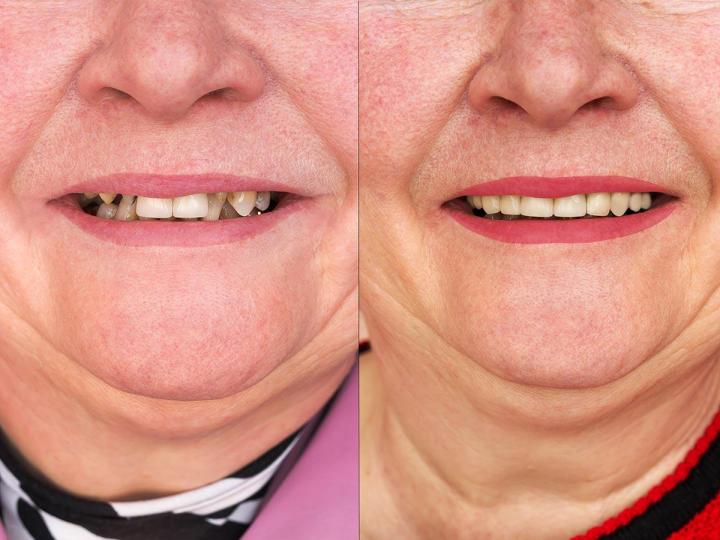 Le blanchiment des dents peut-il traiter les taches profondes ?, Montréal