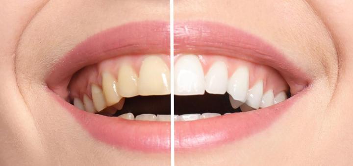 Quels sont les avantages du détartrage régulier pour vos dents ? Montréal