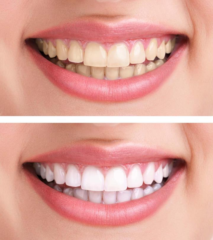 Blanchiment des dents Montréal
