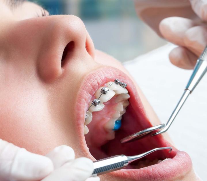 Traitement endodontique Montréal